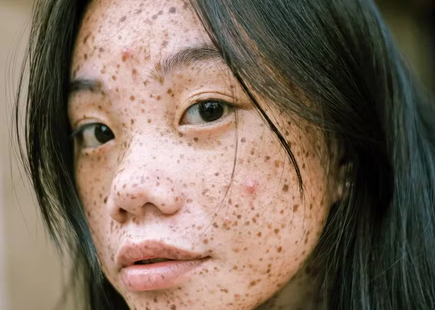 Tudo o que você precisa saber sobre a hiperpigmentação da pele