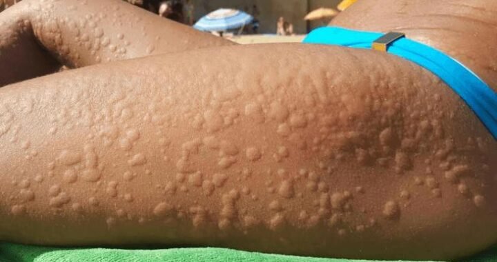 Dia Mundial da Alergia – 8 de julho